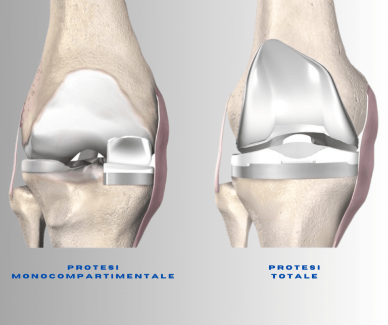 protesi totale o monocompartimentale
