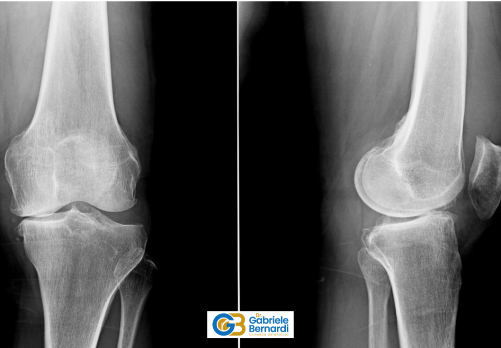 Gonartrosi monocompartimentale mediale 2