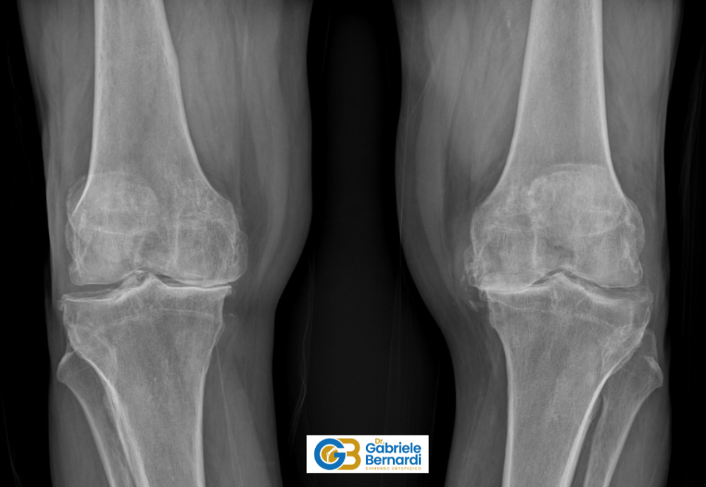 Gonartrosi tricompartimentale bilaterale